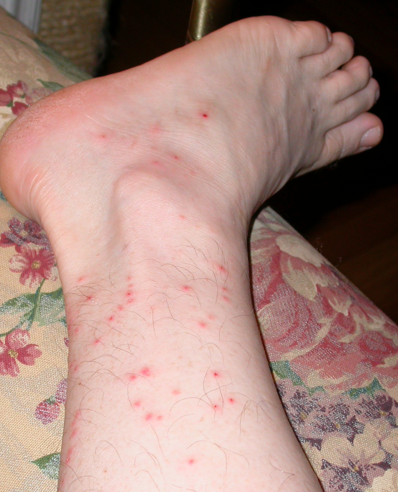 A foot with round, red bites from chiggers/redbugs.