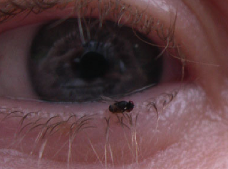 An eye gnat on a person's lower eyelid. It is small and black.