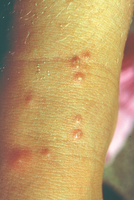 Ant bites on an arm are pink, raised welts on the skin