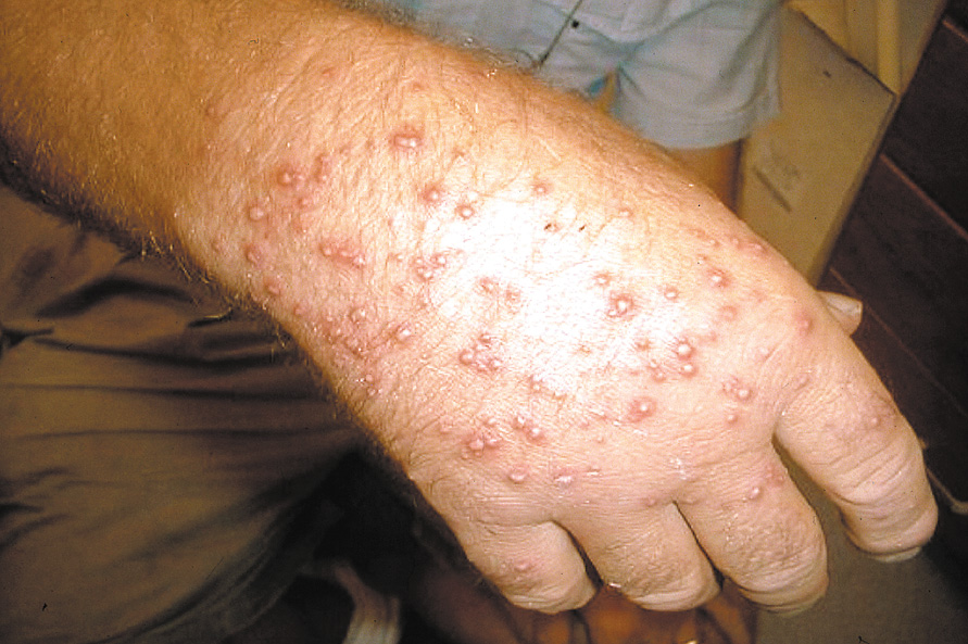 A hand covered in ant bites is swollen with red raised bumps